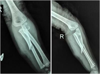 The diagnosis and treatment of a special rare type of Monteggia equivalent fractures in children